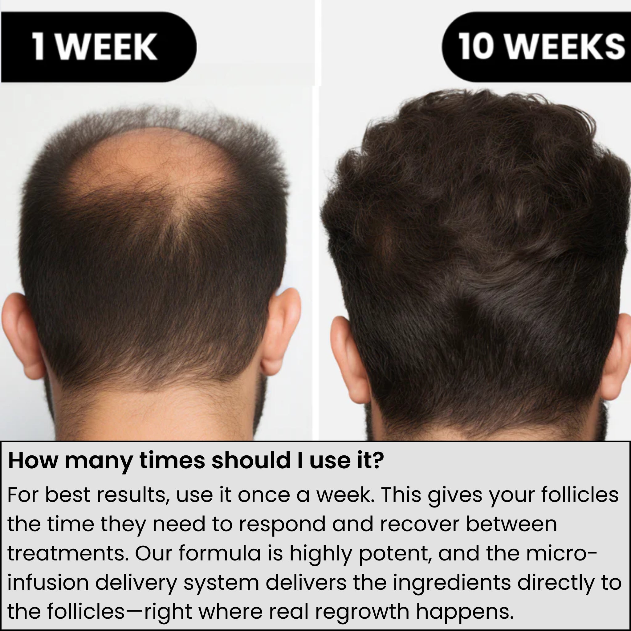 AlphaVance™ Hair Growth System