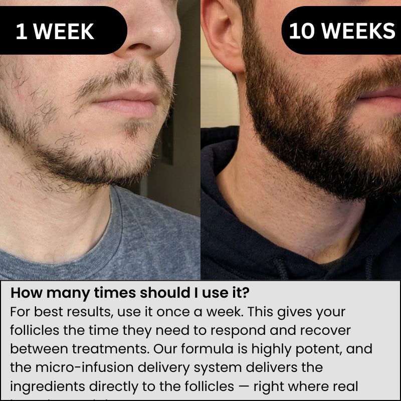AlphaVance™ Beard Growth System